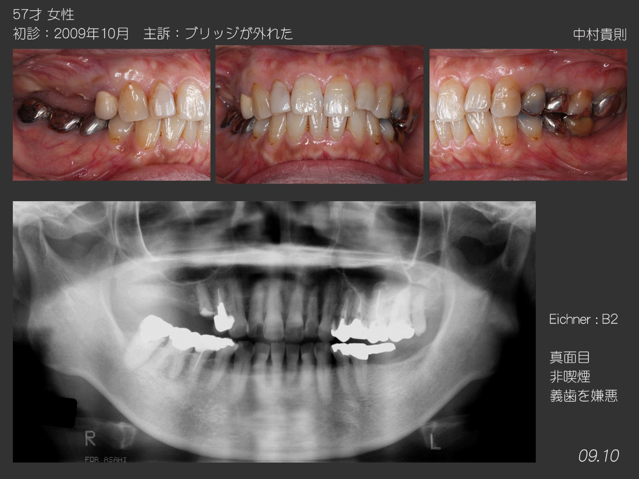 2012臨床歯科を語る会-新人発表事前抄録- 2012臨床歯科を語る会-新人発表事前抄録-